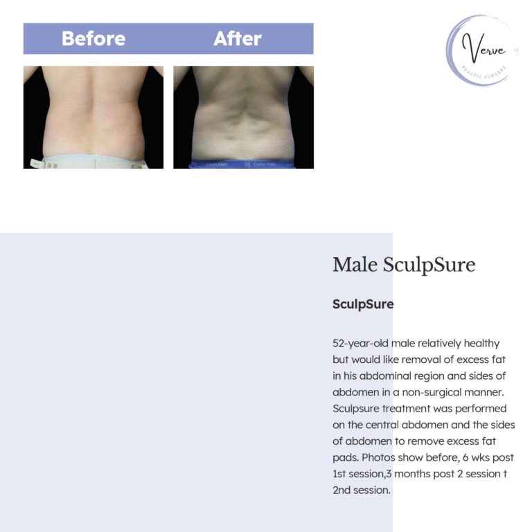 Before and After images of Male SculpSure, SculpSure - 52 year old male relatively healthy but would like removal of excess fat in his abdominal region and sides of abdomen in a non-surgical manner. Sculpsure treatment was performed on the central abdomen and the sides of abdomen to remove excess fat pads. Photos show before, 6 wks post 1st session, 3 months post 2 session + 2nd session.