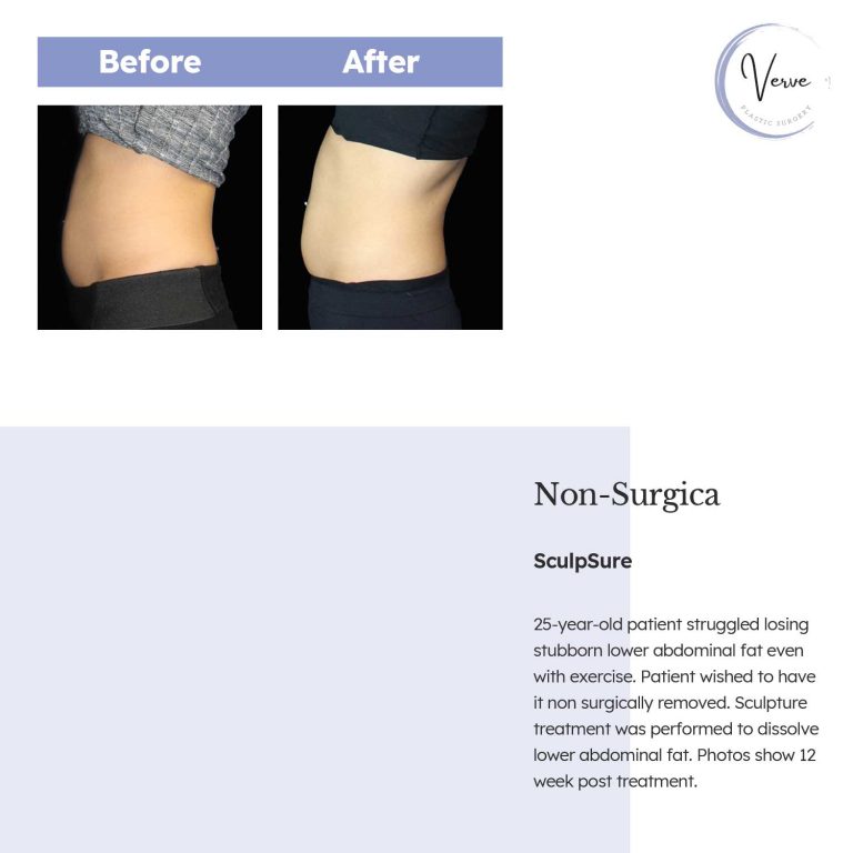 Before and After Image of Non-Surgica Sculpsure - 25 year old patient struggled losing stubborn lower abdominal fat even with exercise. Patient wished to have it non surgically removed. Sculpture treatment was performed to dissolve lower abdominal fat. Photos show 12 week post treatment.