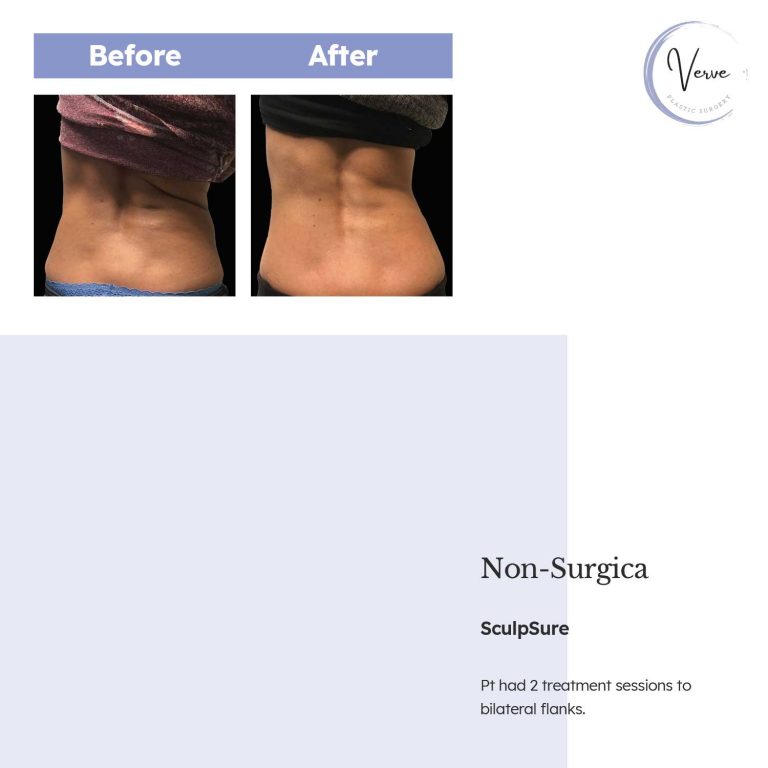 Before and After image of Non-Surgica SculpSure - Patient had 2 treatment sessions to bilateral flanks.