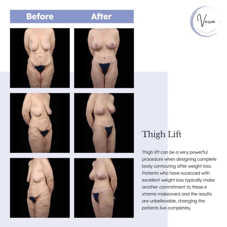 Before and After images of Thigh Lift - Thigh lift can be a very powerful procedure when designing complete body contouring after weight loss. Patients who have suceeded with excellent weight loss typically make another commitment to these extreme makeovers and the results are unbelievable, changing the patients live completely.