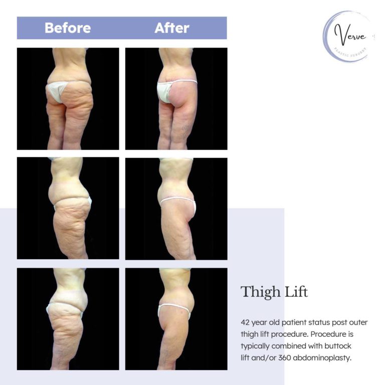 Before and After images of Thigh Lift - 42 year old patient status post outer thigh lift procedure. Procedure is typically combined with buttock lift and/or 360 abdominoplasty.