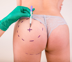 Butt Augmentation Surgery