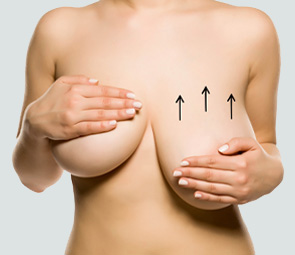 Breast Lift