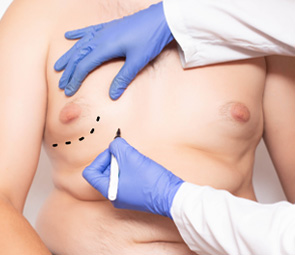 Male Breast Reduction/Gynecomastia