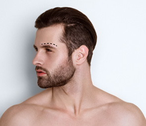 Male Brow Lift