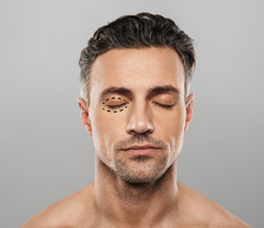 Male Eyelid Surgery