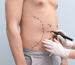 Male Liposuction