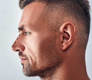 Male Rhinoplasty