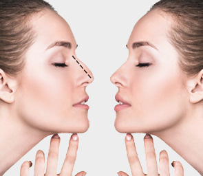 Rhinoplasty Surgery