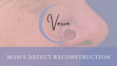 VDO Cover Procedure - Moh's Defect Reconstruction