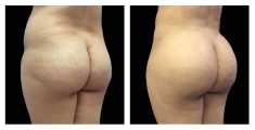 Brazilian Butt Lift - Before and After