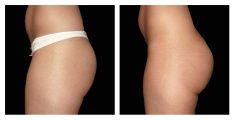 Buttock Implants Before and After