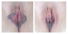 Labiaplasty - Before and After