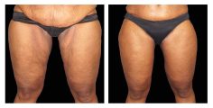 Body Thigh Lift - Before and After