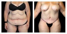 Tummy Tuck - Before and after