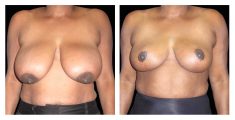 Before and after breast reduction