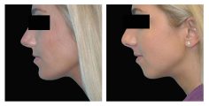 Chin Augmentation - Before and After