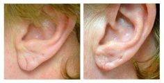 Ear Lobe Repair - Before and After