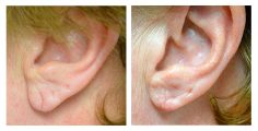 Ear Lobe Repair Surgery, Ear Lobe Repair Treatment - Sakhiya Skin Clinic