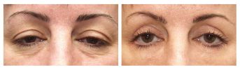 Eyelid Surgery - Before and After