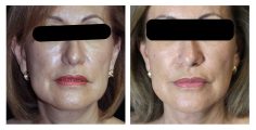 Facial Fat Grafting - Before and After