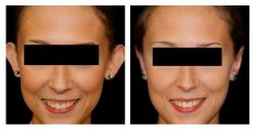 Otoplasty - Before and After