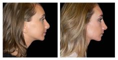 Rhinoplasty - Before and After