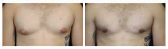 Male Breast Reduction - Before and After