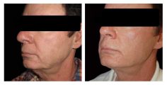 Male Facial Fat Grafting - Before and After