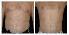 Male Liposuction - Before and After