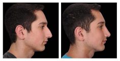 Male Rhinoplasty - Before and After