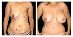DIEP flap - Before and After
