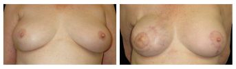 Latissimus Flap - Before and After