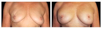 Lumpectomy Reconstruction - Before and After